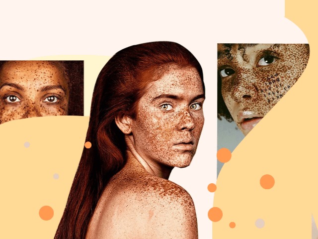 Пигментация на коже: причины, виды и как бороться